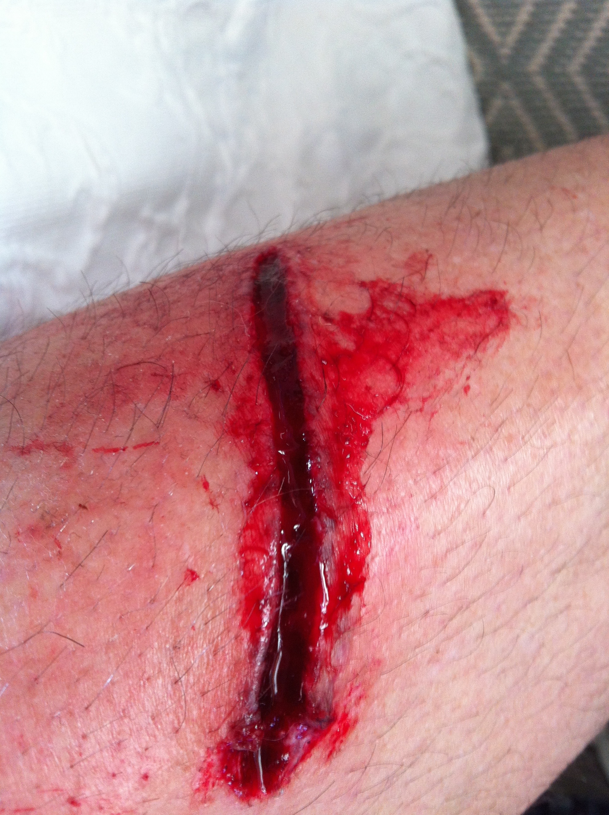 leg wound #10